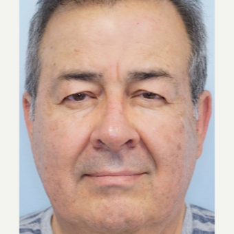 55-64 year old man treated with Ptosis Surgery before 3727832