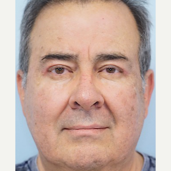 55-64 year old man treated with Ptosis Surgery after 3727832