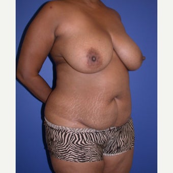 Mommy Makeover before 1681686