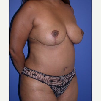 Mommy Makeover after 1681686