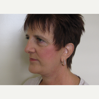 55-64 year old woman treated with Facelift after 3439732