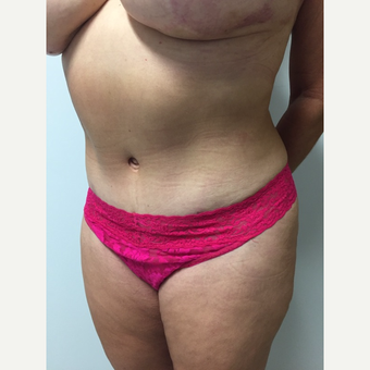 52 year old woman treated with Tummy Tuck and Liposuction after 3676629
