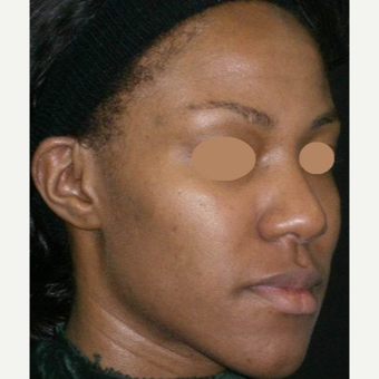 25-34 year old woman treated with Chemical Peel before 3150301