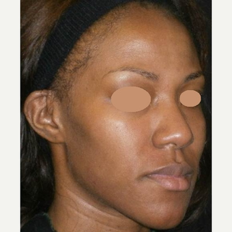 25-34 year old woman treated with Chemical Peel after 3150301