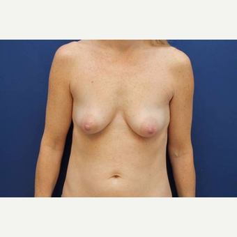 40 year old female, 375cc silicone gel high profile breast implants, submuscular before 3814604