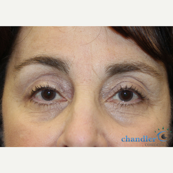 65-74 year old woman treated with Ptosis Surgery after 3108047