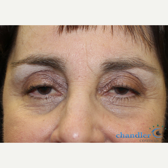 65-74 year old woman treated with Ptosis Surgery before 3108047