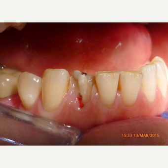 Instant crowns made and fitted in one hour before 2654471