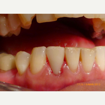 Instant crowns made and fitted in one hour after 2654471