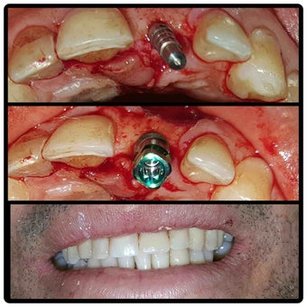 Dental implants Dominican republic before 2197969