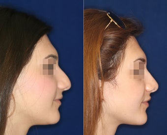 Nose Surgery before 1430611