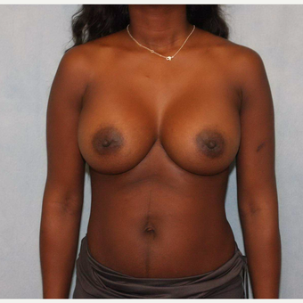 35-44 year old woman treated with Breast Augmentation after 3487527
