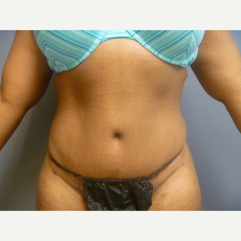 35-44 year old female presented for a tummy tuck. after 2693914
