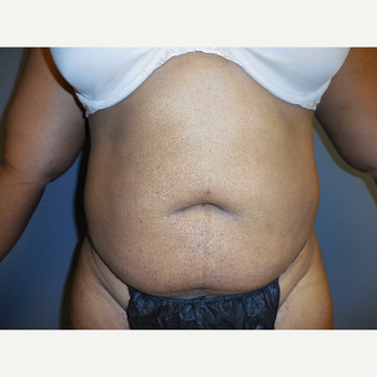 35-44 year old female presented for a tummy tuck. before 2693914