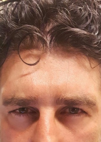 35-44 year old man treated with Botox after 3482108