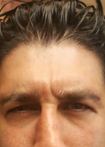 35-44 year old man treated with Botox before 3482108