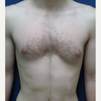 18-24 year old man treated with Male Breast Reduction before 3123051