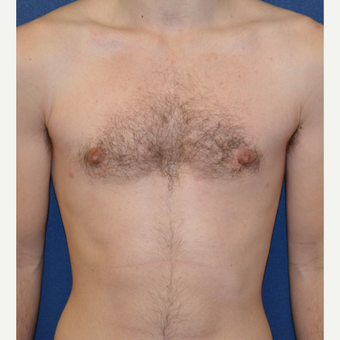 18-24 year old man treated with Male Breast Reduction after 3123051