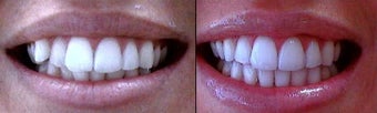 Invisalign before 109368