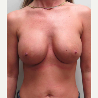 Mentor Breast Implants for this 38 Year Old Woman before 3006138