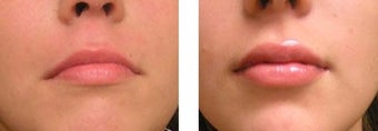 Lip Fillers - Injectable Fillers after 3093676