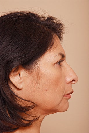 Brow Lift before 1393958
