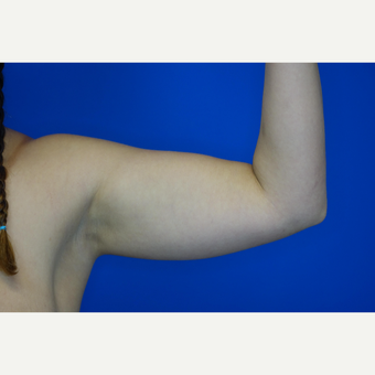 25-34 year old woman treated with Laser Liposuction before 3377066