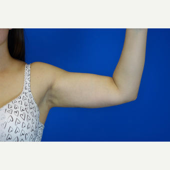 25-34 year old woman treated with Laser Liposuction after 3377066