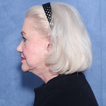 65-74 year old woman treated with Neck Lift (view 2 of 2) before 3175477