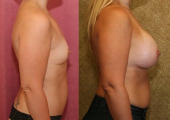 Breast Augmentation with 400 cc Mentor Saline Implants 453337