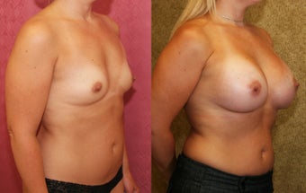 Breast Augmentation with 400 cc Mentor Saline Implants 453337