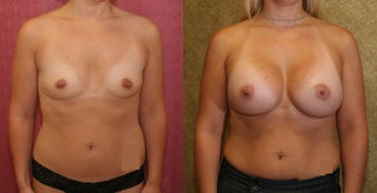 Breast Augmentation with 400 cc Mentor Saline Implants before 453337
