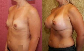 Breast Augmentation with 400 cc Mentor Saline Implants after 453337