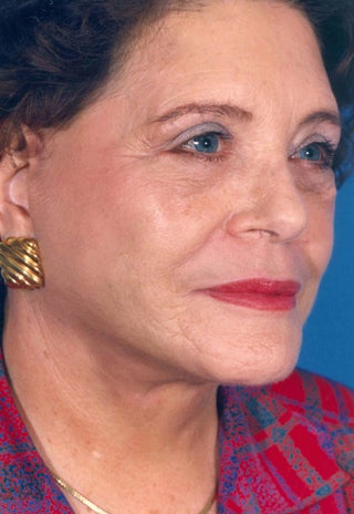 Facelift 1047983