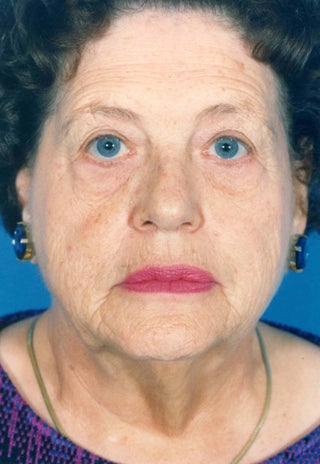 Facelift before 1047983