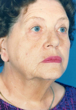 Facelift 1047983