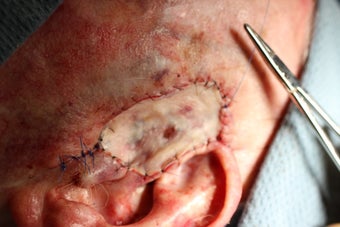Before and after Mohs removal of a complicated squamous cell carcinoma after 1125299