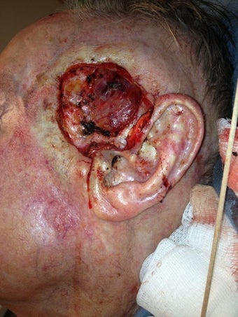 Before and after Mohs removal of a complicated squamous cell carcinoma before 1125299