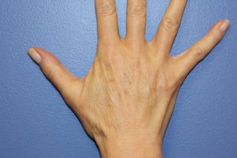 Hand rejuvenation with Juvederm after 1487253