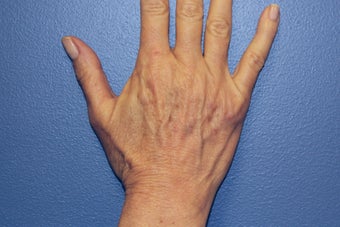 Hand rejuvenation with Juvederm before 1487253