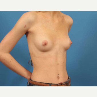 18-24 year old woman treated with Breast Augmentation with Shaped Implants (Gummy Bear) before 3787205