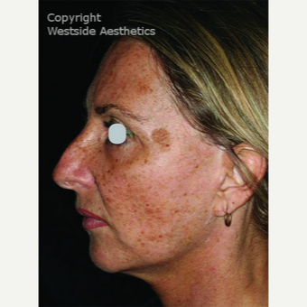CO2 Laser for Sun Damage and Wrinkles before 3075708