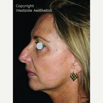 CO2 Laser for Sun Damage and Wrinkles after 3075708