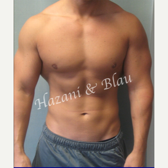 18-24 year old man treated with Male Breast Reduction after 3332907