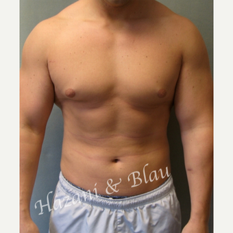 18-24 year old man treated with Male Breast Reduction before 3332907