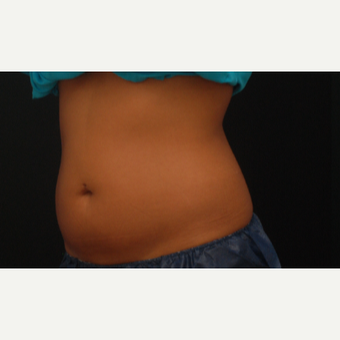 25-34 year old woman treated with CoolSculpting before 3287614