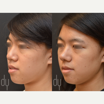 Asian Rhinoplasty with Rib cartilage before 3622585