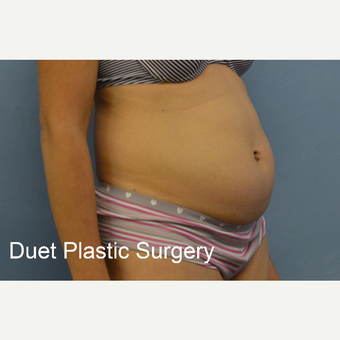 45-54 year old woman treated with Tummy Tuck before 3368734
