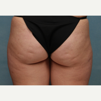 25-34 year old woman treated with CoolSculpting before 3224510