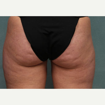 25-34 year old woman treated with CoolSculpting after 3224510
